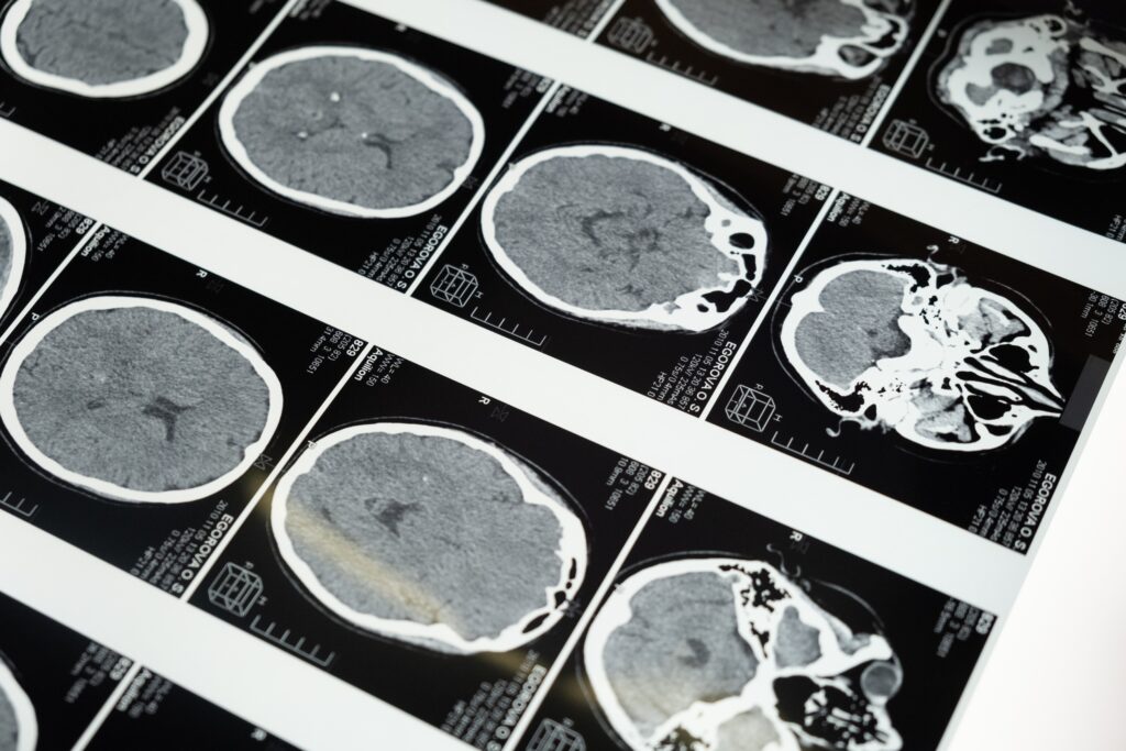 Meningitis adalah